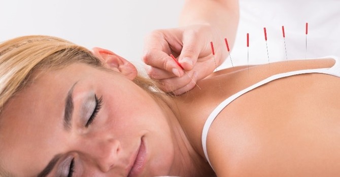 Acupuncture for Pain Relief: A Holistic Approach image